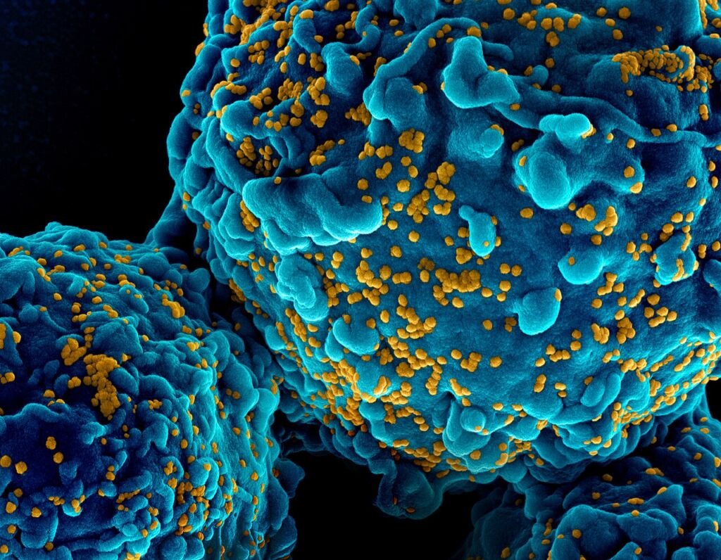 Micrografía electrónica coloreada de partículas del VIH-1 infectando células